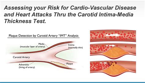 carotid intima media thickness measurement|intima media thickness test results.